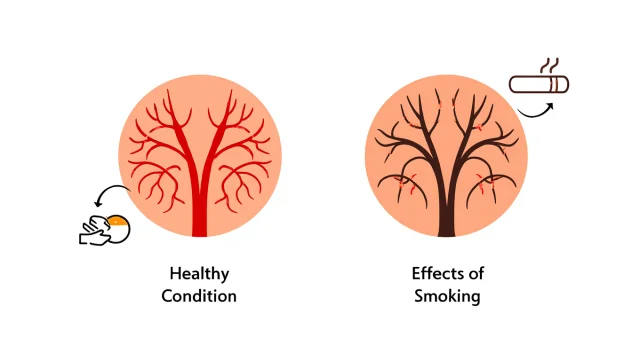 喫煙による頭皮の血行不良を示すイラスト